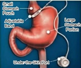 臺灣減重減肥手術