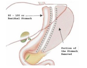 胃袖狀切除手術(縮胃手術)減重