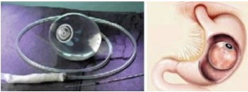 胃內水球(非手術)減輕體重